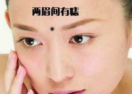 克夫痣,哪里长痣会克夫